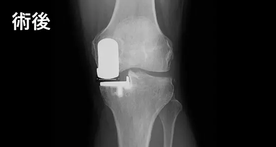 人工膝関節手術の例：術後