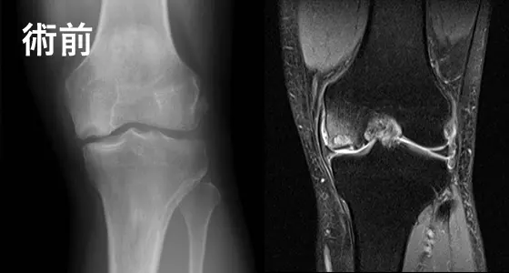 人工膝関節手術の例：術前