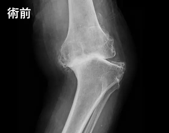人工膝関節手術の例：術前
