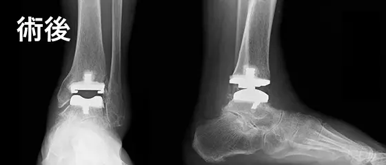 人工足関節手術の例：術後