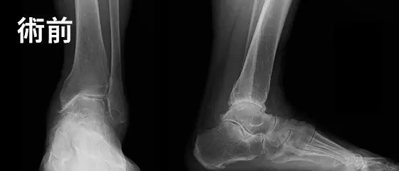 人工足関節手術の例：術前